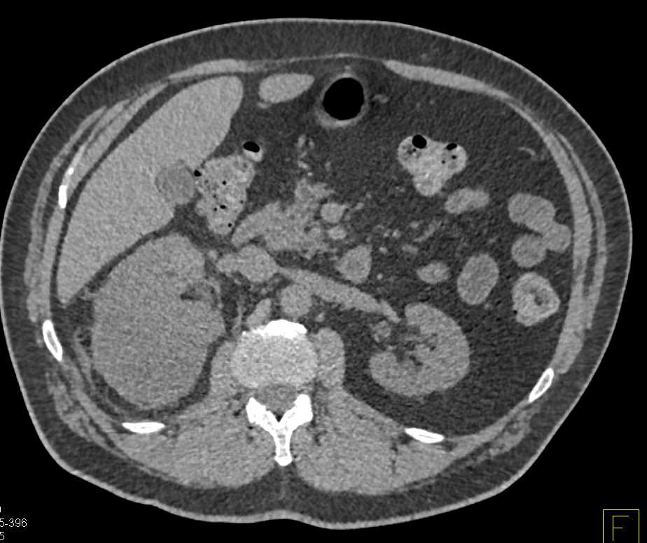 Page Kidney Right Kidney - CTisus CT Scan