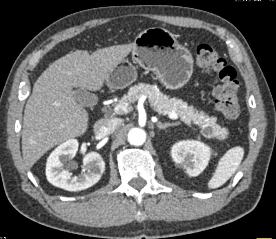 Renal Cell Carcinoma Metastatic to the Tail of the Pancreas - CTisus CT Scan
