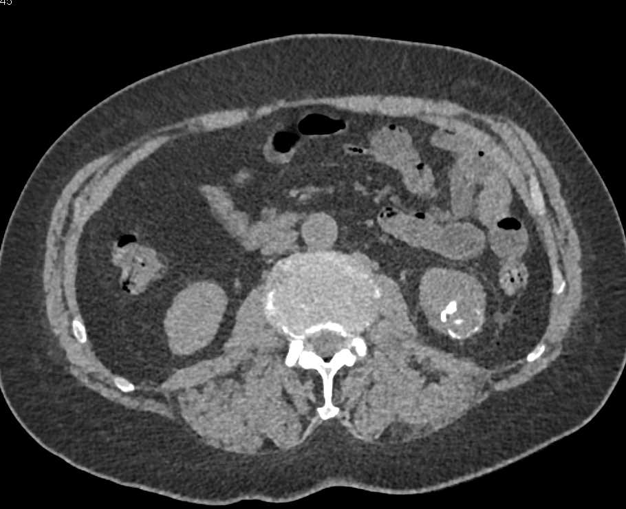 Carcinoma Lower Pole Left Kidney with Bone Metastases - CTisus CT Scan