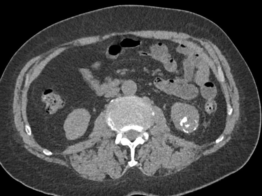 Papillary Renal Cell Carcinoma Lower Pole Left Kidney with Bone Metastases - CTisus CT Scan