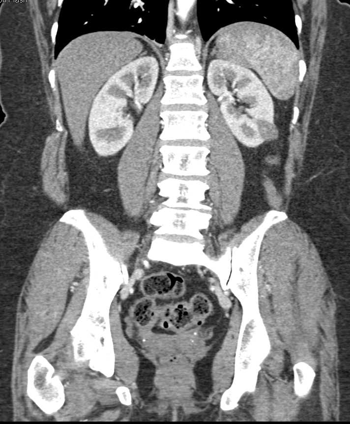 Papillary Renal Cell Carcinoma Left Kidney with Minimal Enhancement - CTisus CT Scan