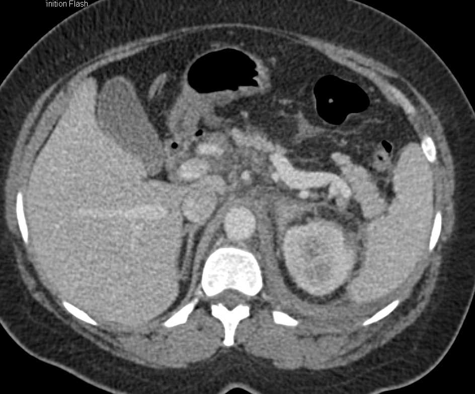 Lymphomatous Infiltration of the Left Kidney with Adenopathy - CTisus CT Scan