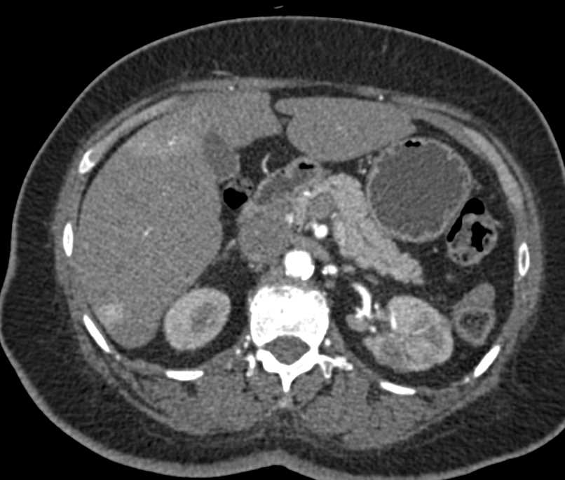 Liver Metastases from a Renal A Renal Cell Carcinoma - CTisus CT Scan
