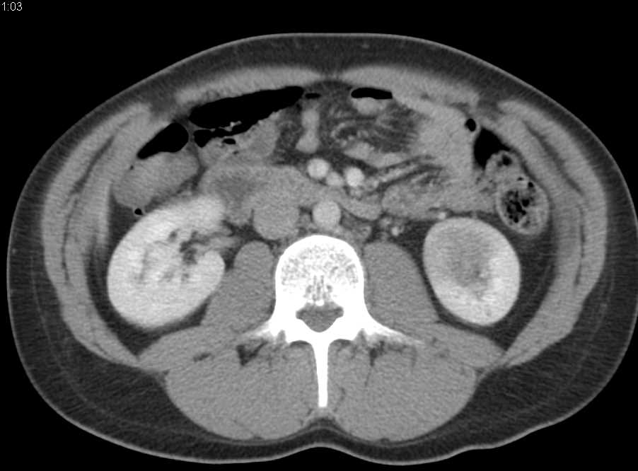 Transitional Cell carcinoma Lower Pole Left Kidney - CTisus CT Scan