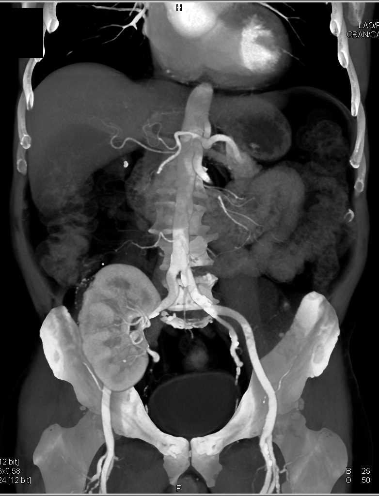 Renal Transplant and Subsequent Lymphoma - CTisus CT Scan