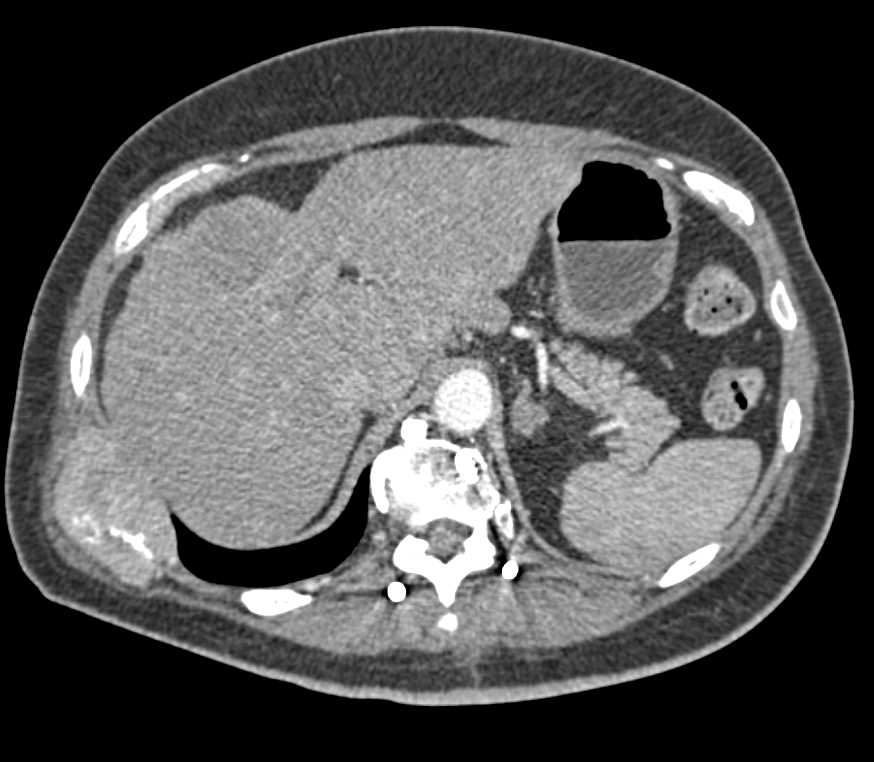 Metastatic Renal cell carcinoma to Bone and Pancreas - CTisus CT Scan