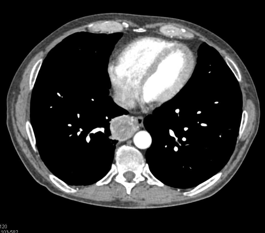 Metastatic Renal Cell Carcinoma to Chest and Heart - CTisus CT Scan