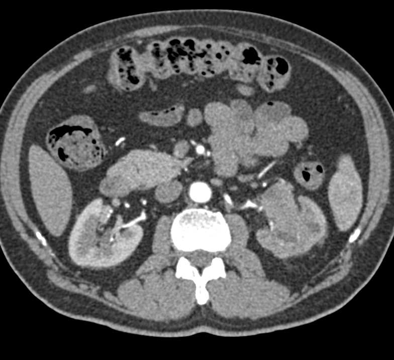Transitional Cell Carcinoma Left Kidney - CTisus CT Scan