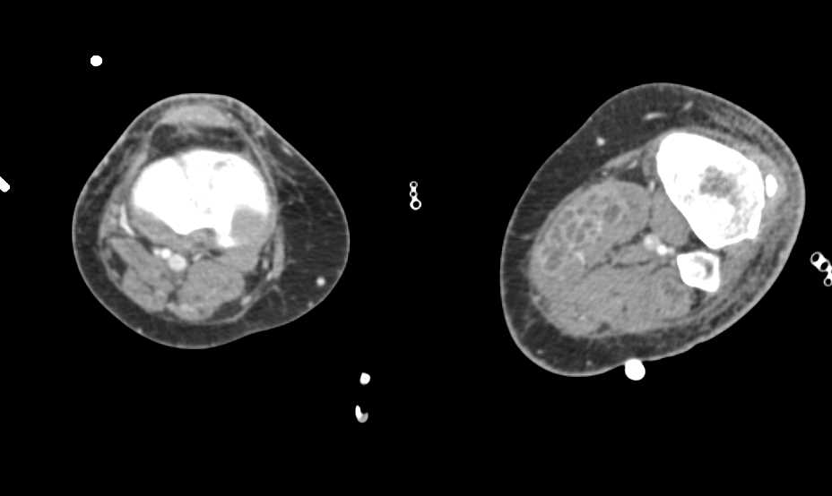 Contrast Extravasation in the Forearm - CTisus CT Scan