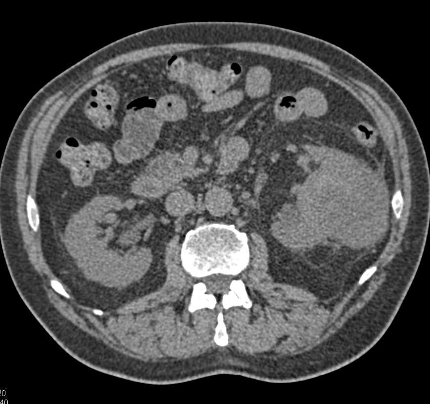 Very Necrotic Papillary Left Renal Cell Carcinoma - CTisus CT Scan