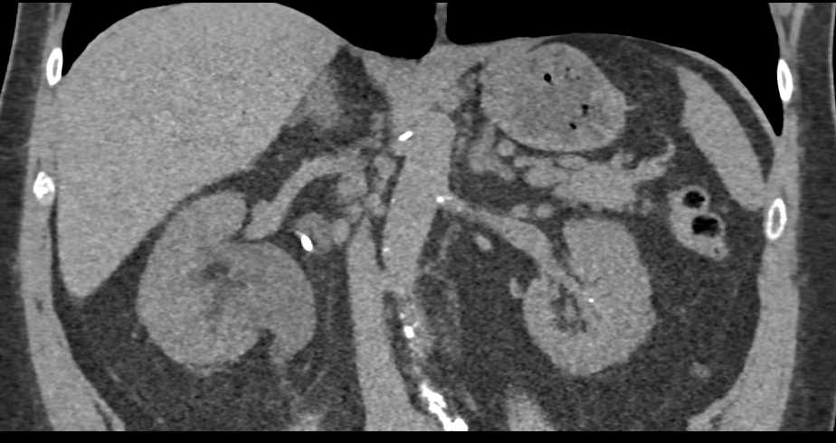 Duplicated Collecting System Right Kidney with Obstruction - CTisus CT Scan