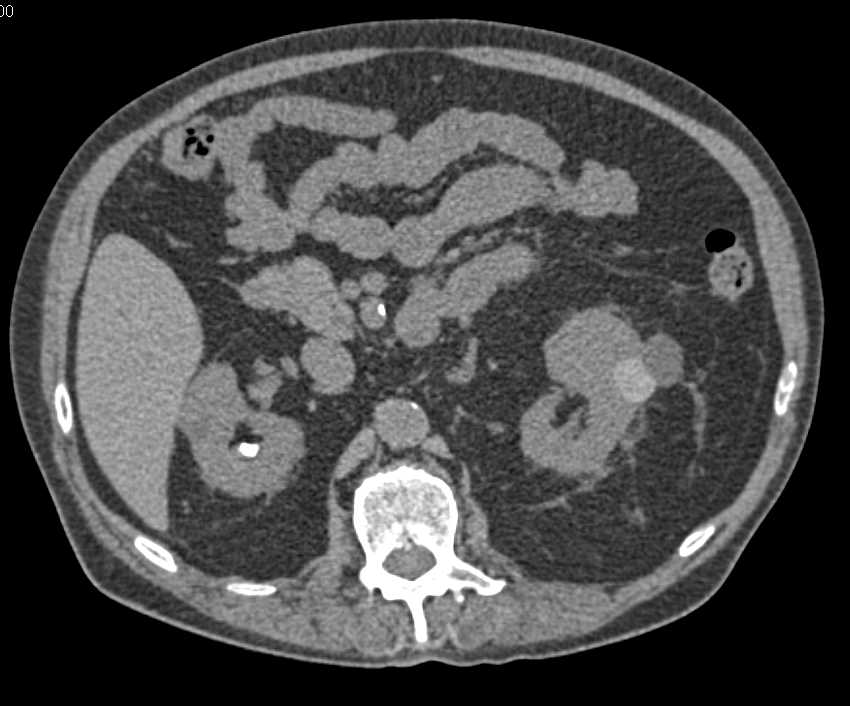 High Density Cyst Left Kidney - CTisus CT Scan