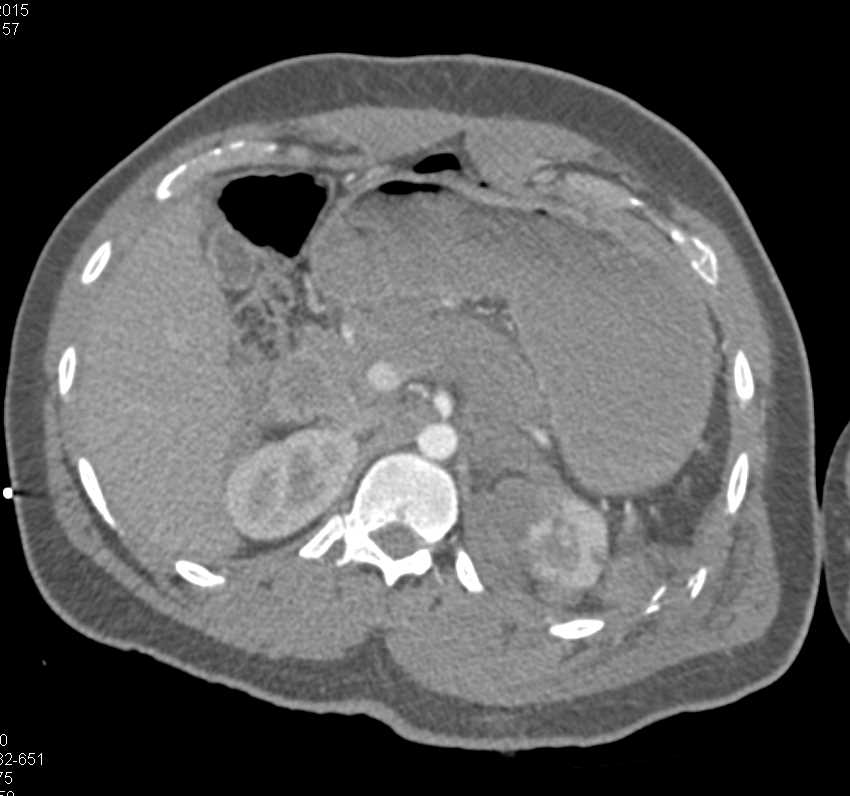Renal Laceration with Hematoma and Posterior Left Rib Fracture - CTisus CT Scan