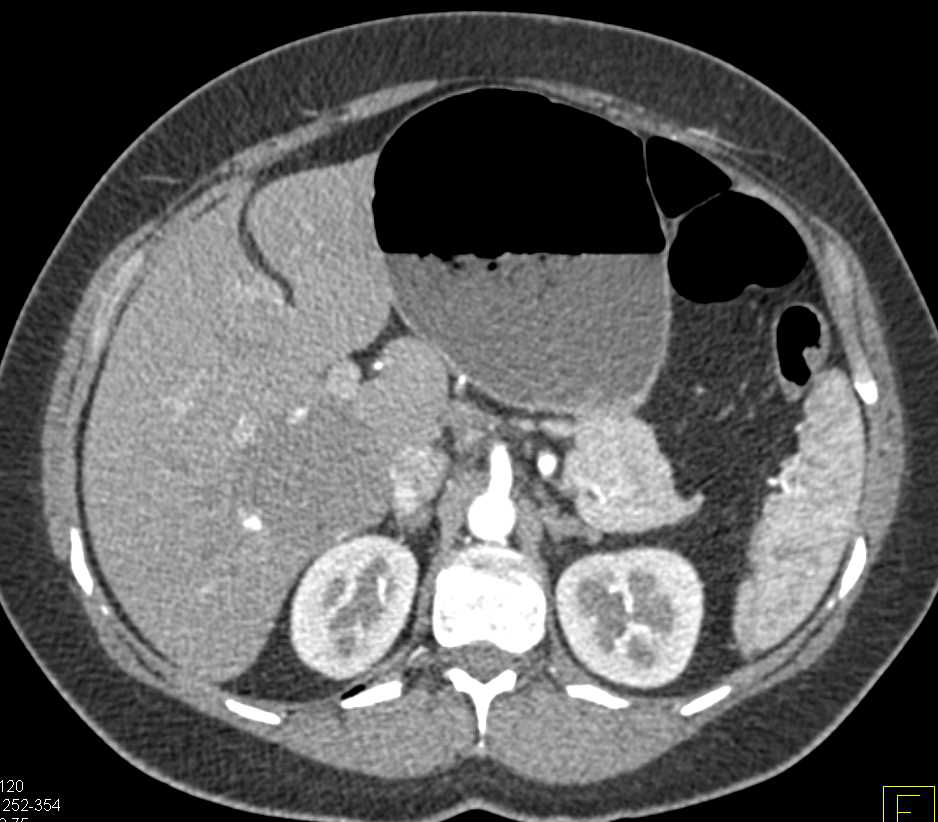 Renal Cell carcinoma with Metastases to the Seminal Vesicle - CTisus CT Scan