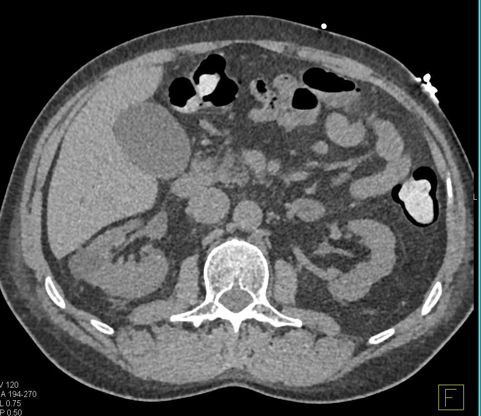 Papillary Renal Cell Carcinoma in Lower Pole Right Kidney - CTisus CT Scan