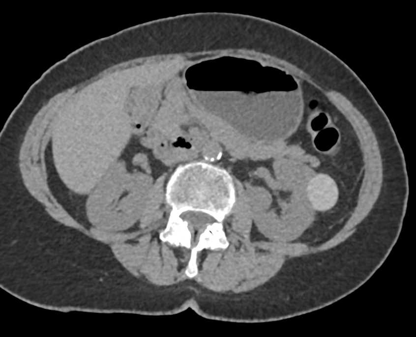 High Density Left Renal Cyst - CTisus CT Scan