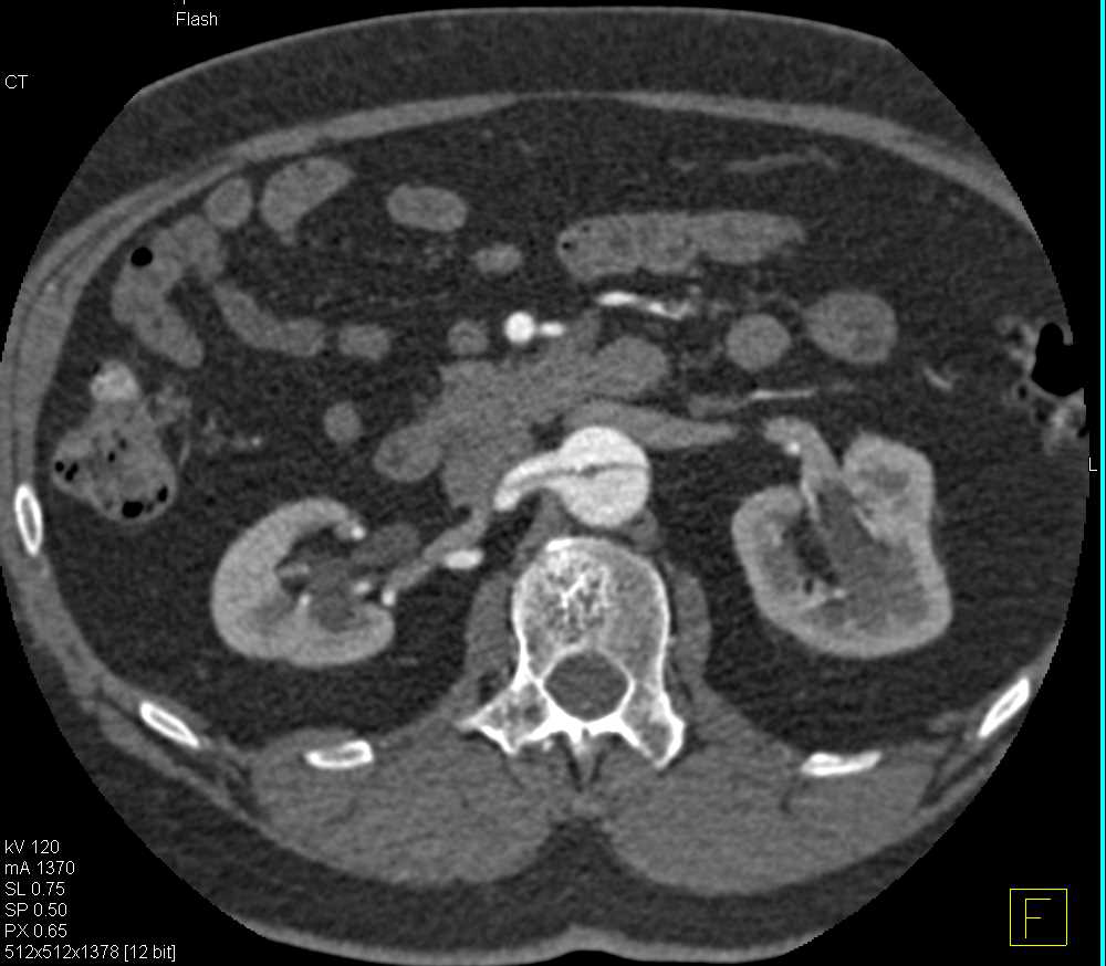 Aortic Dissection Extends Into the Right Renal Artery - CTisus CT Scan