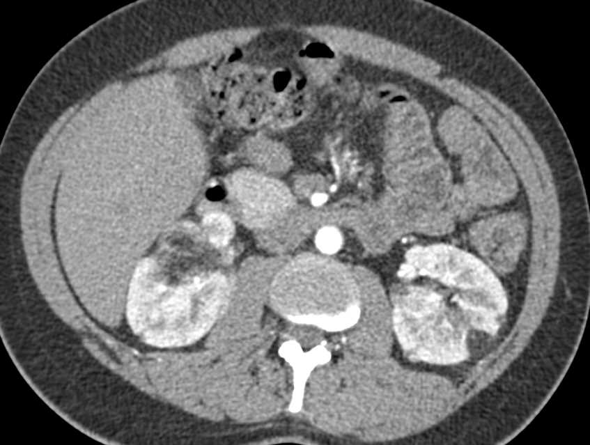 Bilateral Renal Angiomyolipomas (AMLs) in Patient with Tuberous Sclerosis - CTisus CT Scan