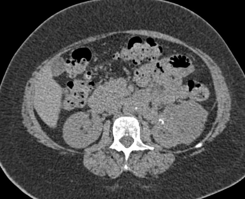 Renal Cell Carcinoma Involves the Renal Vein - CTisus CT Scan