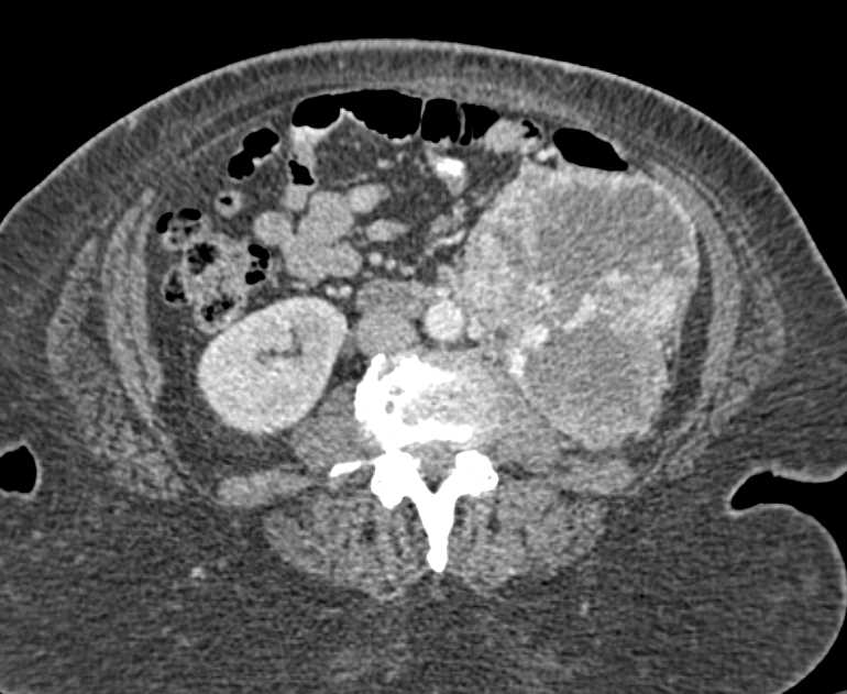 Clear Cell Renal Cell Carcinoma - CTisus CT Scan