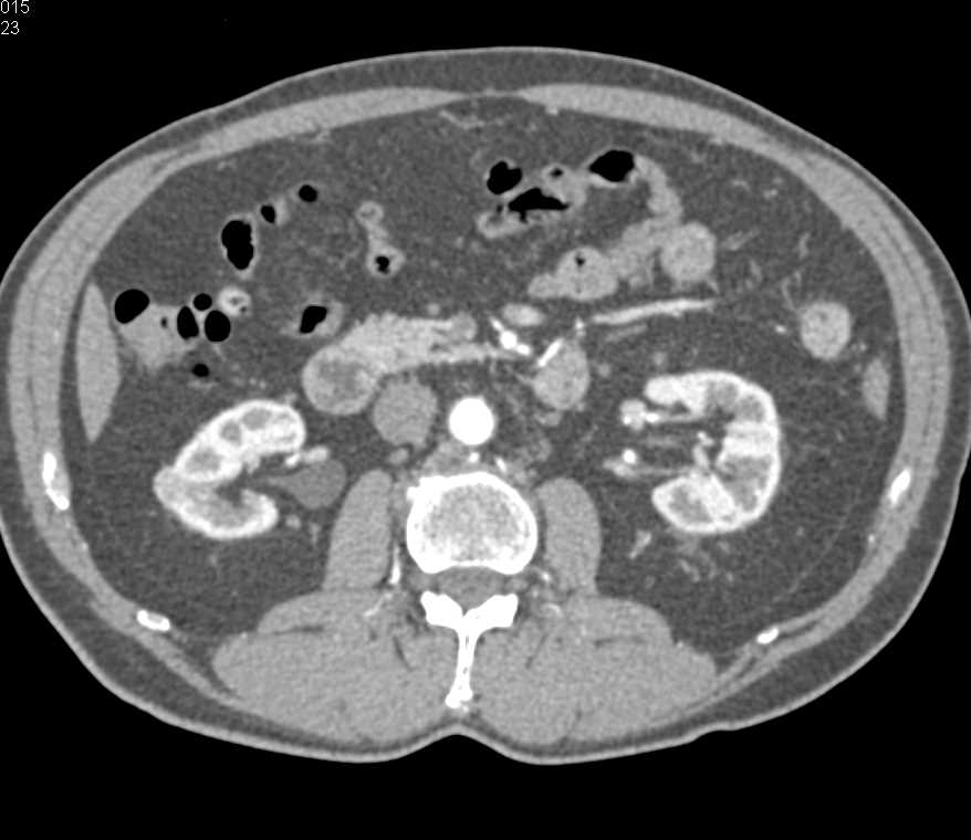 1cm Right Papillary Renal Cell Carcinoma - CTisus CT Scan