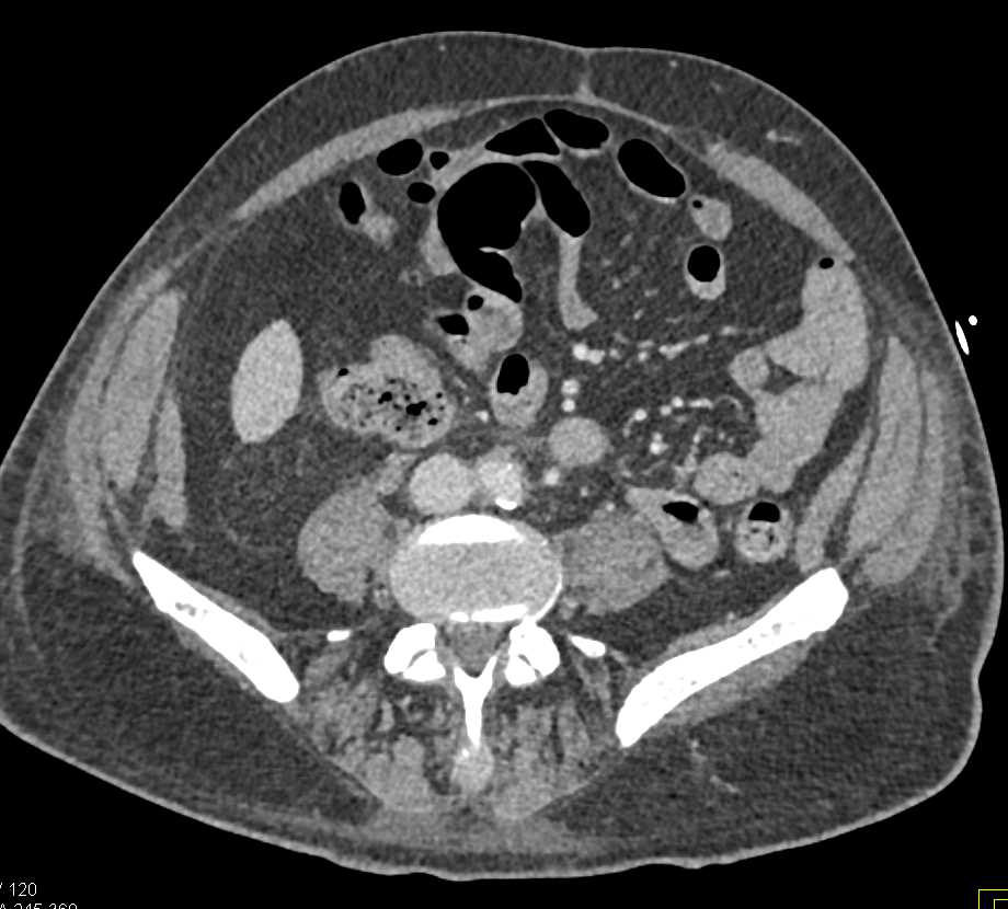 Carcinoma of the Right Ureter - CTisus CT Scan