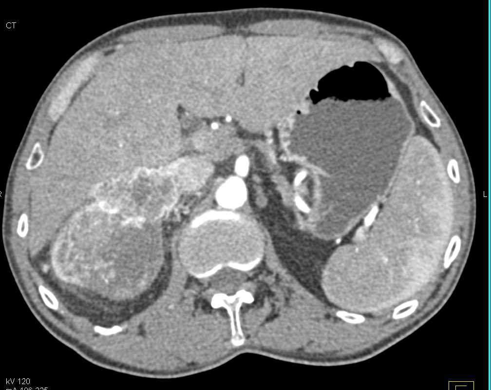 Clear Cell Renal Cell Carcinoma Invades the Renal Vein and Inferior Vena Cava (IVC) - CTisus CT Scan