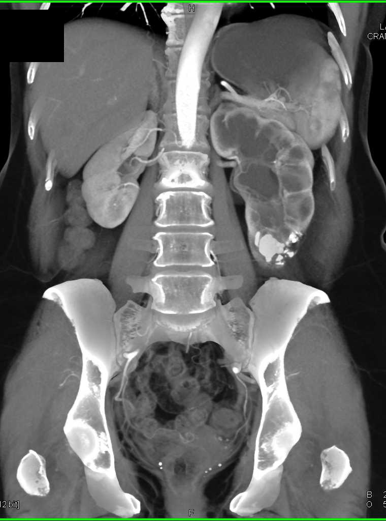 Calcifications Lower Pole Left Kidney - CTisus CT Scan