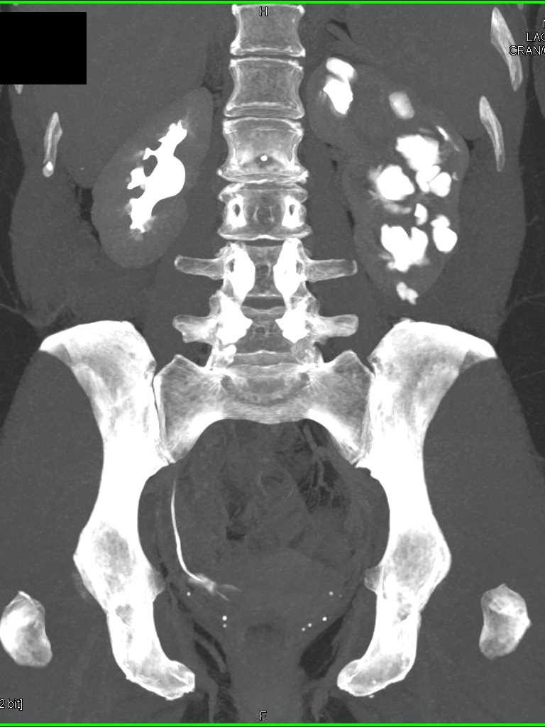 Calcifications Lower Pole Left Kidney - CTisus CT Scan
