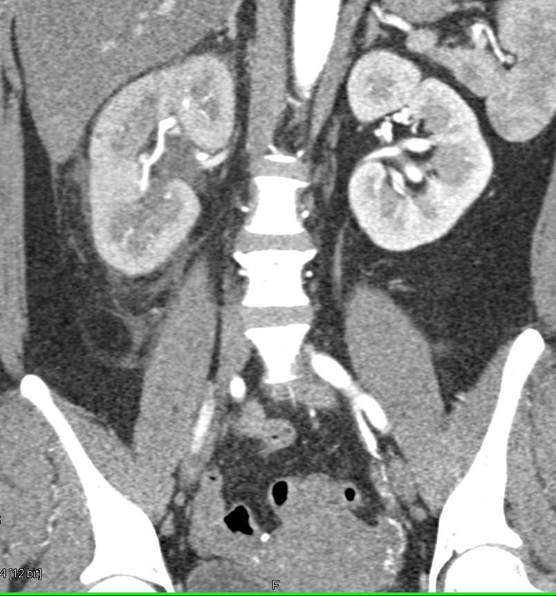 Obstructing Stone in the Proximal Right Ureter with Delayed Function Right Kidney - CTisus CT Scan