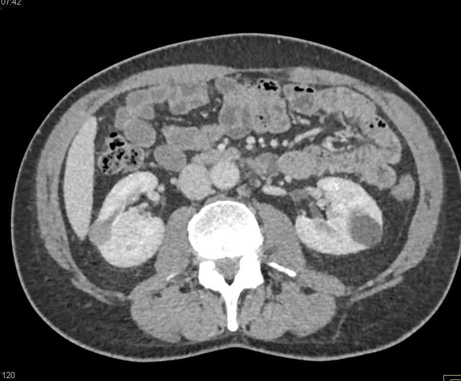 High Density Right Renal Cyst on Multiple Phases - CTisus CT Scan