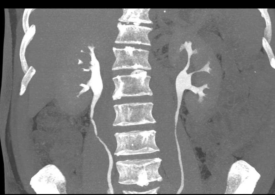 Perirenal Bleed Post Biopsy - CTisus CT Scan