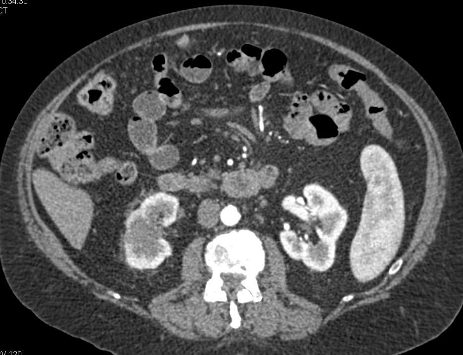 Transitional Cell Carcinoma Right Kidney - CTisus CT Scan