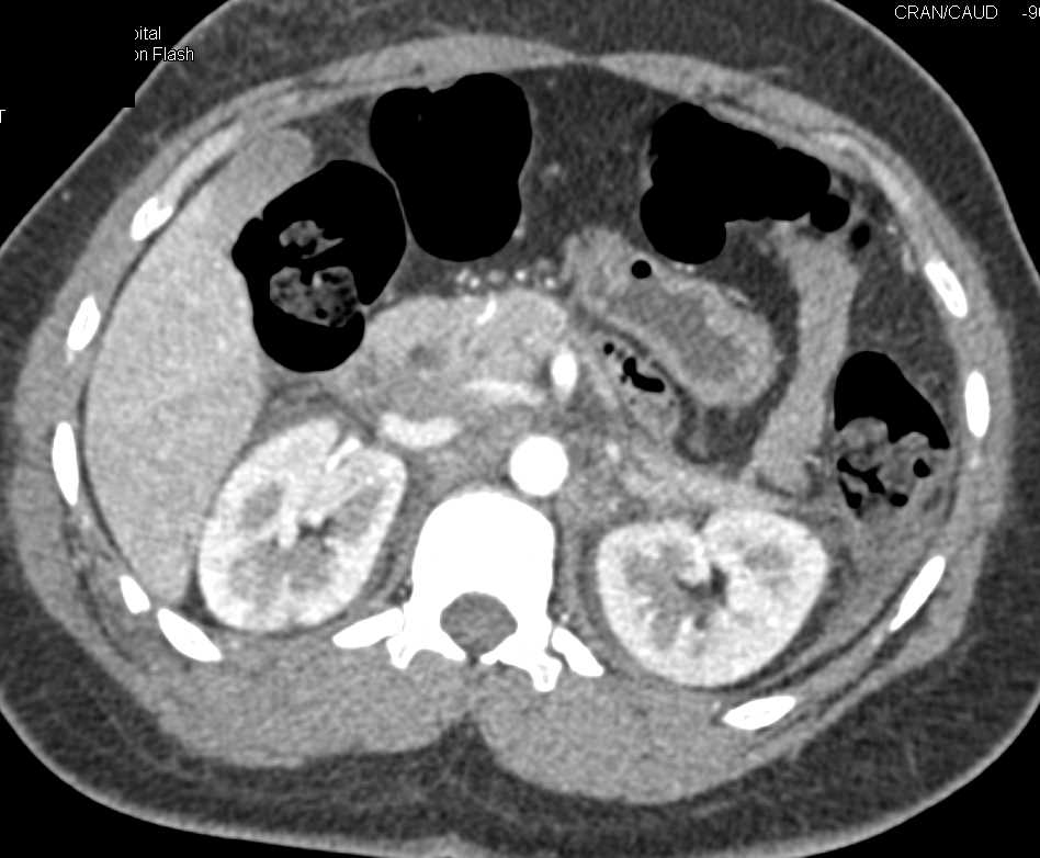 Trauma with Renal Lacerations - CTisus CT Scan
