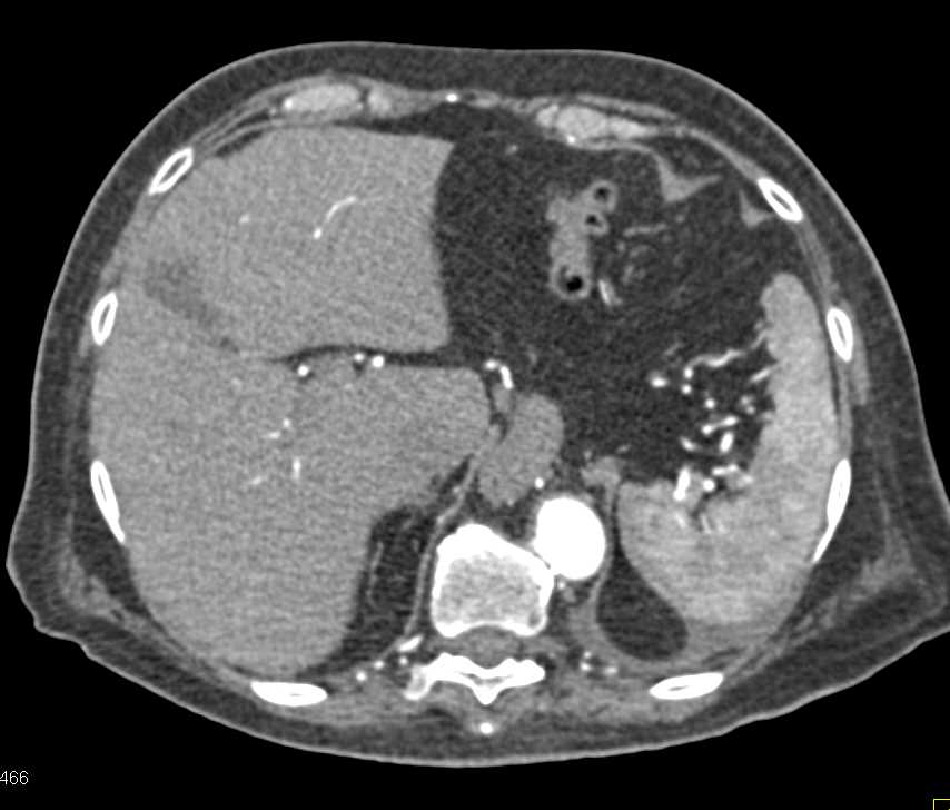 Left Ureteropelvic Junction (UPJ) and Resulting Hydronephrosis - CTisus CT Scan