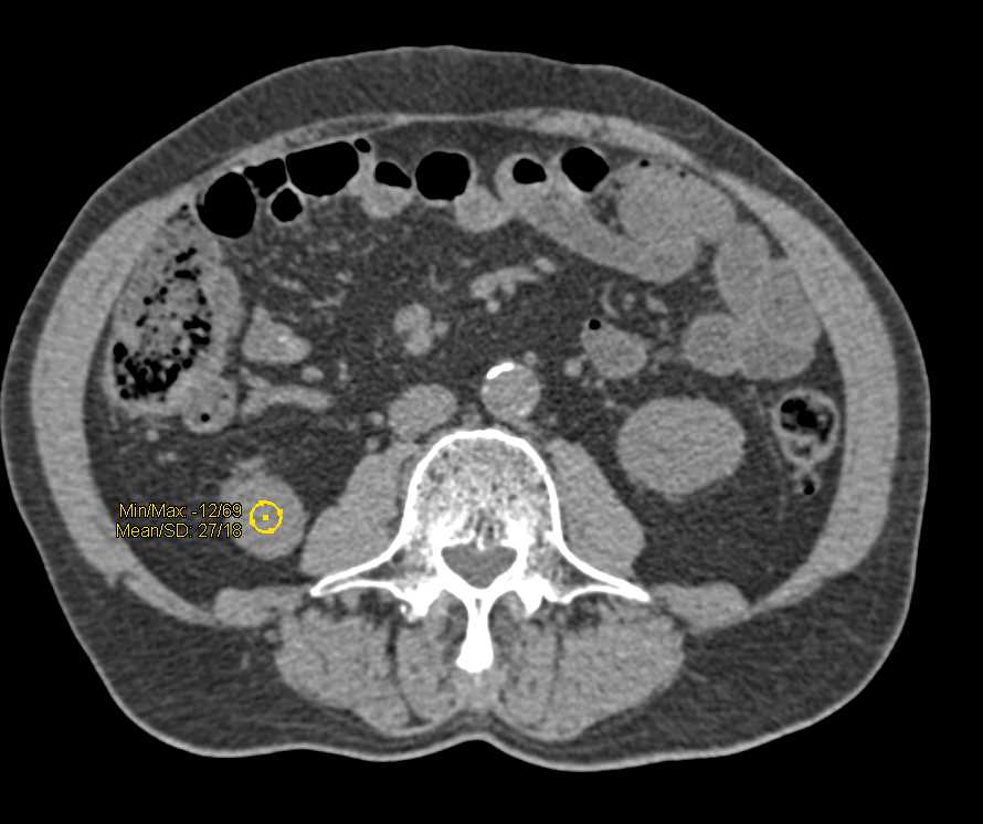 High Density Cyst Lower Pole Right Kidney - CTisus CT Scan