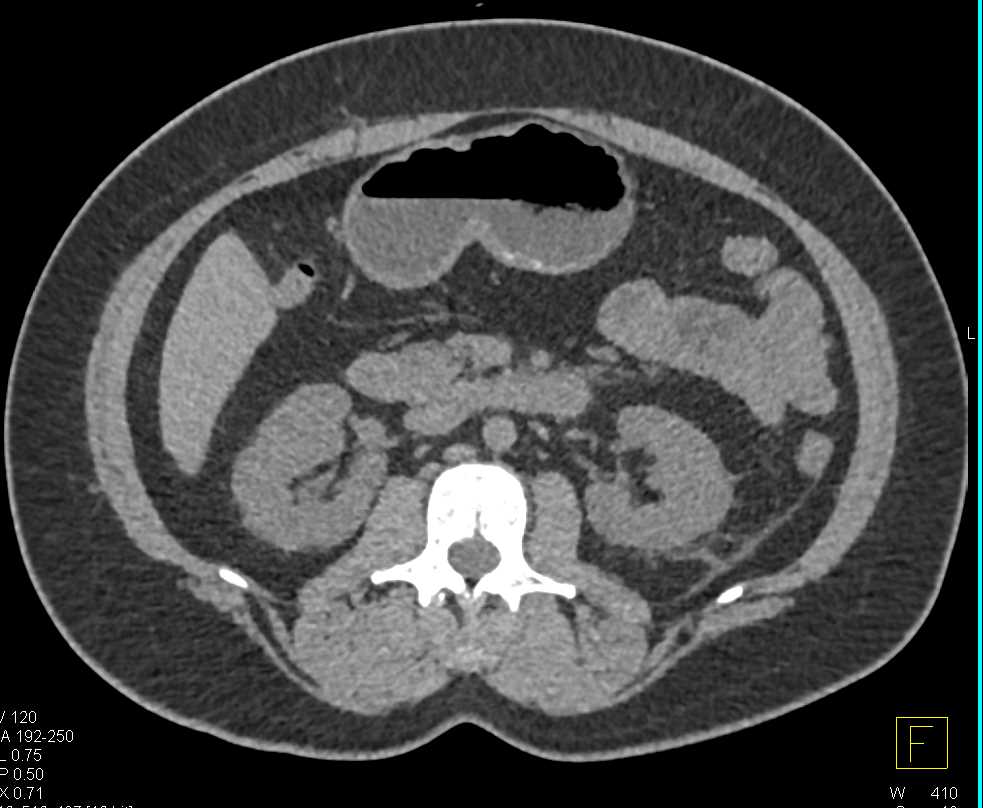 Multiple Small Renal Cell Carcinomas - CTisus CT Scan