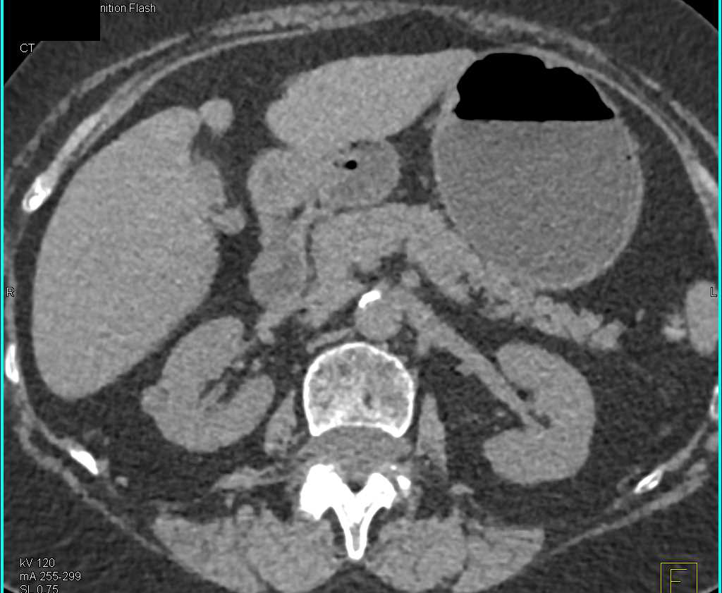 1cm Renal Cell Carcinoma - CTisus CT Scan
