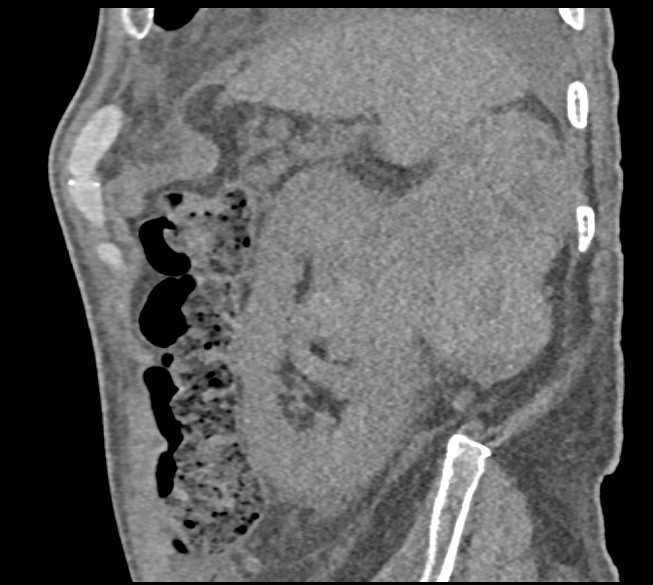 Renal Cell Carcinoma with Lung Metastases and Pulmonary Emboli (PEs) - CTisus CT Scan
