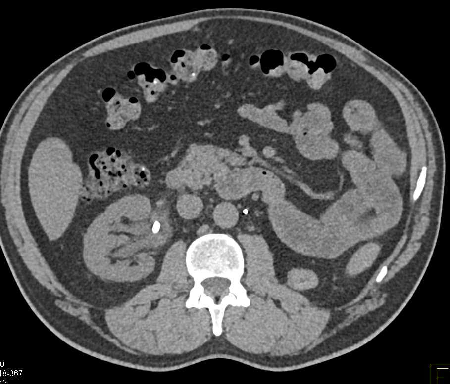 Stone in Right Renal Pelvis - CTisus CT Scan