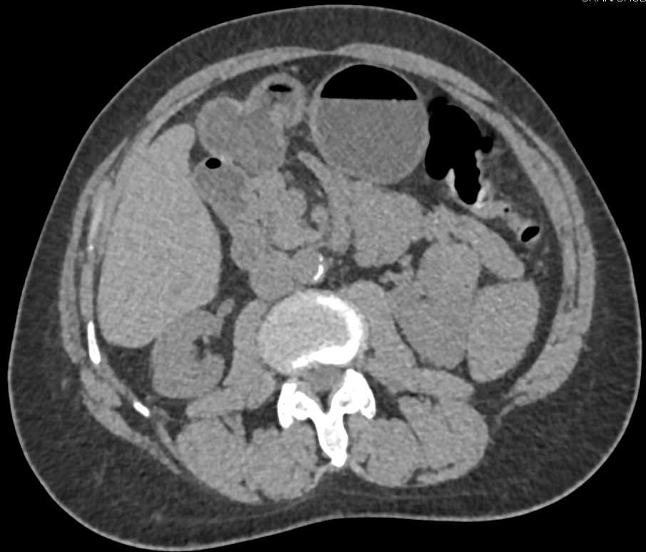 Papillary Renal Cell Carcinoma Left Kidney - CTisus CT Scan