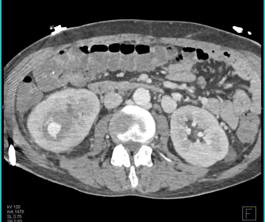 Pseudoaneurysm Right Kidney Following Procedure - CTisus CT Scan