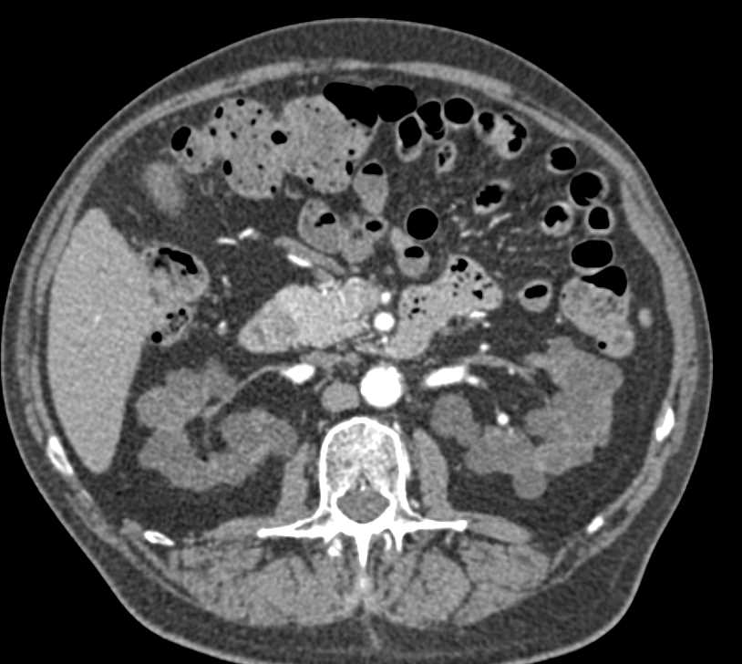 End Stage Renal Disease - CTisus CT Scan