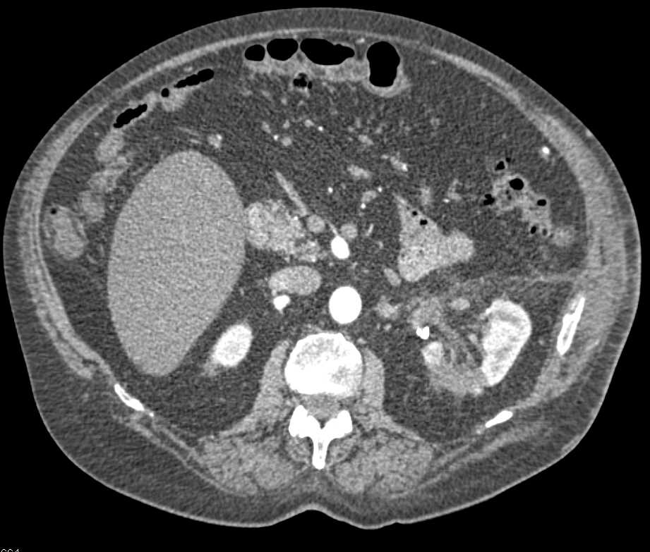 Infarction S/P Partial Nephrectomy - CTisus CT Scan