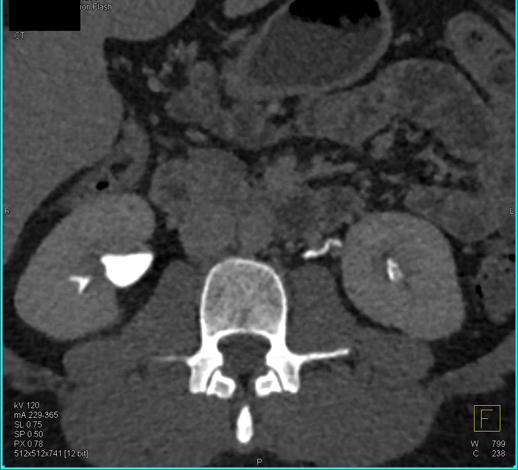 Multifocal Transitional Cell Cancer (TCC) Left Kidney. Left Renal Pelvis and Left Ureter - CTisus CT Scan