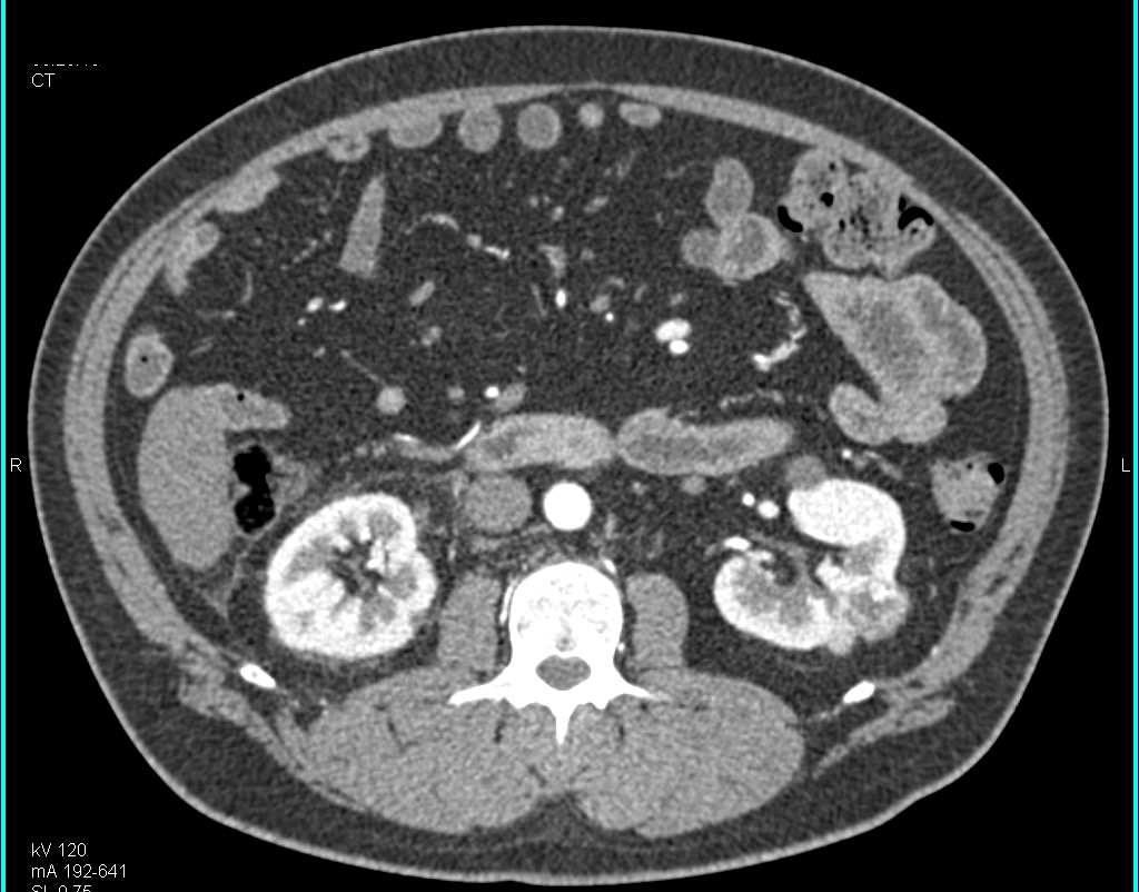 Bilateral Renal Cell Carcinomas - CTisus CT Scan