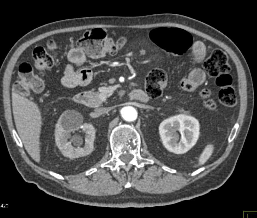 Bladder Cancer Causes Right Hydronephrosis - CTisus CT Scan