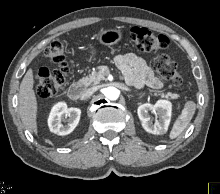Acute Pyelonephritis Left Kidney - CTisus CT Scan