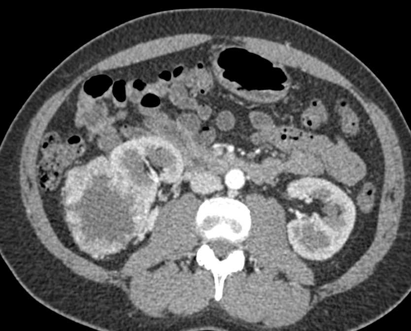 Clear Cell Renal Cell Carcinoma - CTisus CT Scan