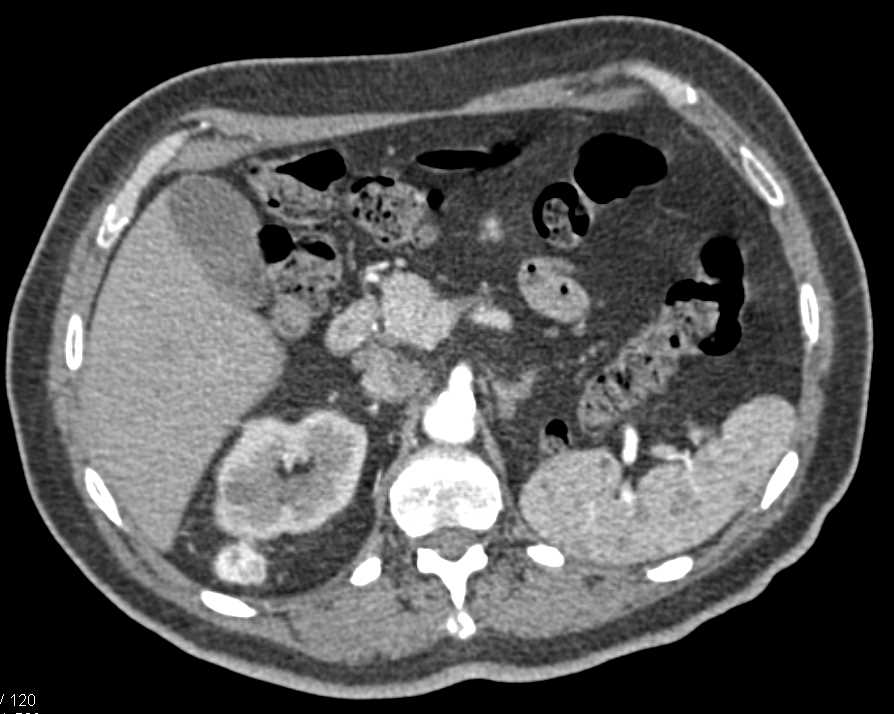 Metastatic Renal Cell Carcinoma to the Right Perirenal Space - CTisus CT Scan